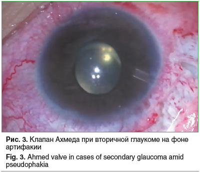 Рис. 3. Клапан Ахмеда при вторичной глаукоме на фоне артифакии Fig. 3. Ahmed valve in cases of secondary glaucoma amid pseudophakia