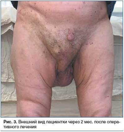 Рис. 3. Внешний вид пациентки через 2 мес. после оперативного лечения