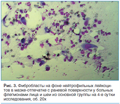 Рис. 3. Фибробласты на фоне нейтрофильных лейкоцитов в мазке-отпечатке с раневой поверхности у больных флегмонами лица и шеи из основной группы на 4-е сутки исследования, об. 20х