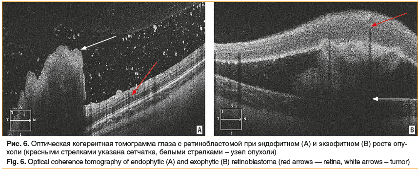 Рис. 6. Оптическая когерентная томограмма глаза с ретинобластомой при эндофитном (А) и экзофитном (В) росте опу- холи (красными стрелками указана сетчатка, белыми стрелками – узел опухоли) Fig. 6. Optical coherence tomography of endophytic (A) and exophyt