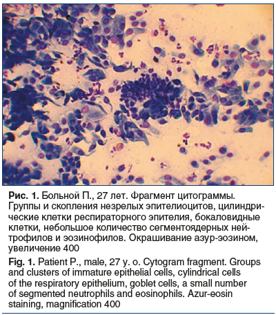 Рис. 1. Больной П., 27 лет. Фрагмент цитограммы. Группы и скопления незрелых эпителиоцитов, цилиндри- ческие клетки респираторного эпителия, бокаловидные клетки, небольшое количество сегментоядерных ней- трофилов и эозинофилов. Окрашивание азур-эозином, у