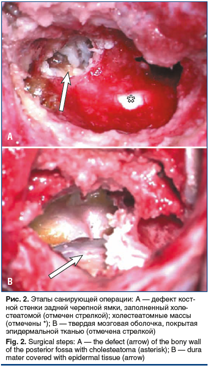 Рис. 2. Этапы санирующей операции: A — дефект кост- ной стенки задней черепной ямки, заполненный холе- стеатомой (отмечен стрелкой); холестеатомные массы (отмечены *); B — твердая мозговая оболочка, покрытая эпидермальной тканью (отмечена стрелкой) Fig. 2