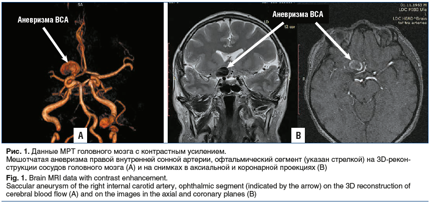 Рис. 1. Данные МРТ головного мозга с контрастным усилением. Мешотчатая аневризма правой внутренней сонной артерии, офтальмический сегмент (указан стрелкой) на 3D-реконструкции сосудов головного мозга (А) и на снимках в аксиальной и коронарной проекциях (В