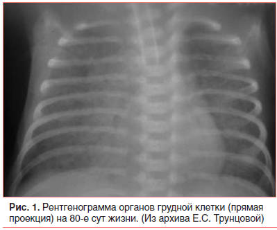 Рис. 1. Рентгенограмма органов грудной клетки (прямая проекция) на 80-е сут жизни. (Из архива Е.С. Трунцовой)