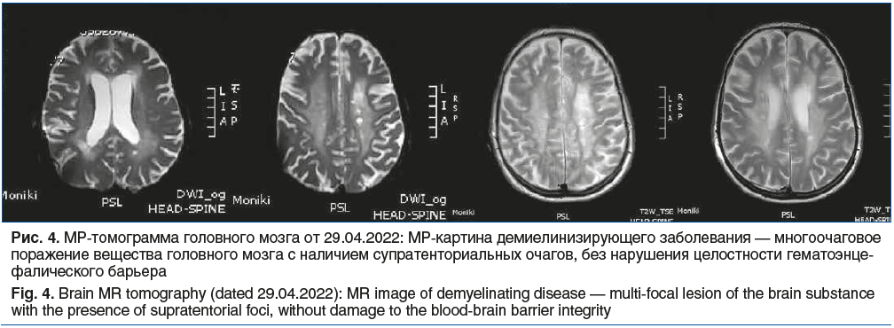 Рис. 4. МР-томограмма головного мозга от 29.04.2022: МР-картина демиелинизирующего заболевания — многоочаговое поражение вещества головного мозга с наличием супратенториальных очагов, без нарушения целостности гематоэнце- фалического барьера Fig. 4. Brain