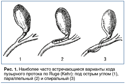 Рис. 1. Наиболее часто встречающиеся варианты хода пузырного протока по Ruge (Kehr): под острым углом (1), параллельный (2) и спиральный (3)