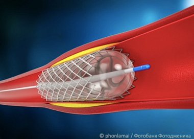 Ангиопластика баллонными катетерами с лекарственным покрытием при заболеваниях артерий нижних конечностей